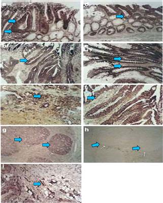 Aquaporins in Cancer Biology